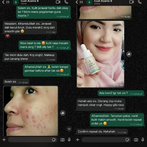 Masalah Parut Jerawat dah banyak pudar dan kulit dah xmerah — Happy kawan2 cakap muka clear dan smooth sangat — Confident sangat nak keluar rumah sekarang.